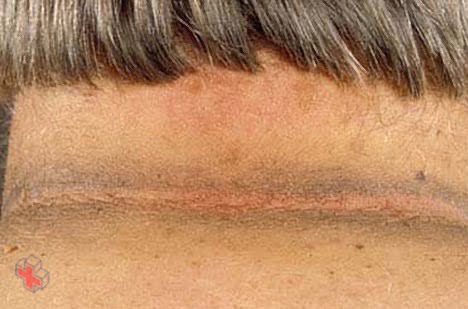 Photo of acanthosis nigricans
