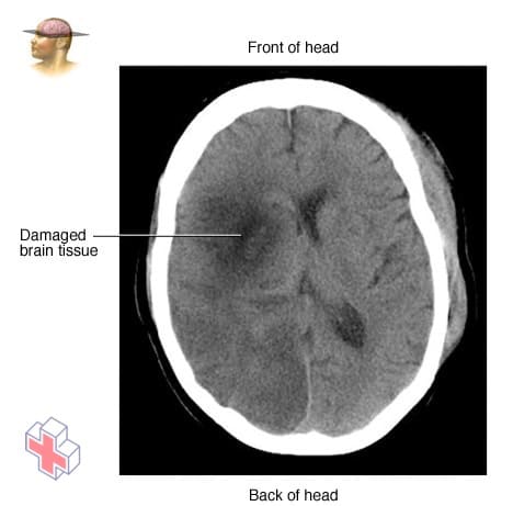 Brain tissue damaged by stroke