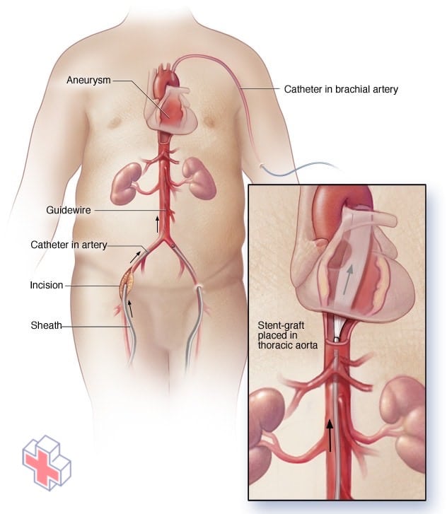 Illustration showing endovascular repair for thoracic aortic aneurysm