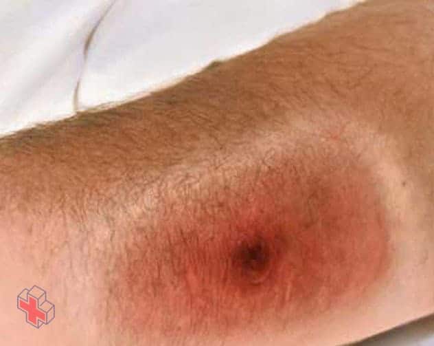 A large sore with a black center, caused by cutaneous anthrax
