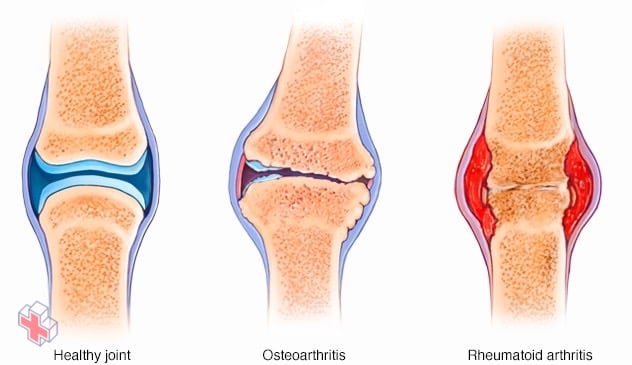 Comparing rheumatoid arthritis and osteoarthritis