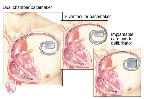 Pacemakers, defibrillator