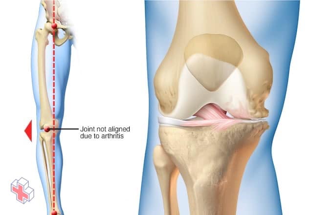 How arthritis can affect just one side of the knee