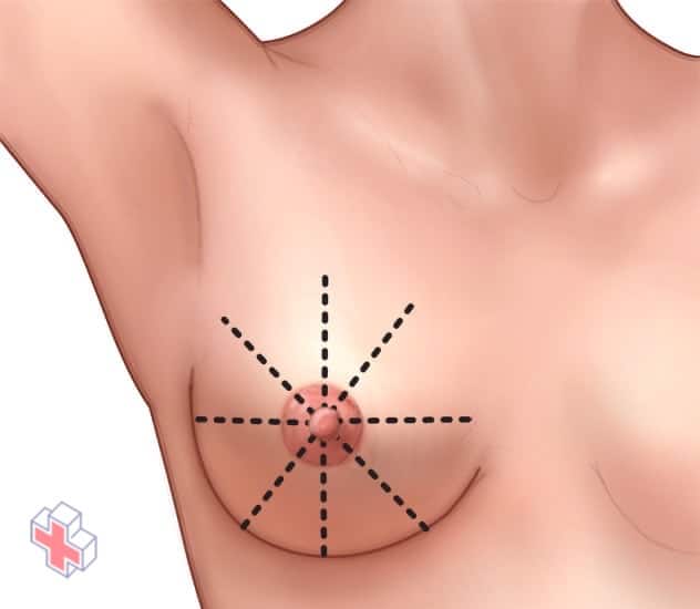 Wedge-shaped pattern for breast self-exam