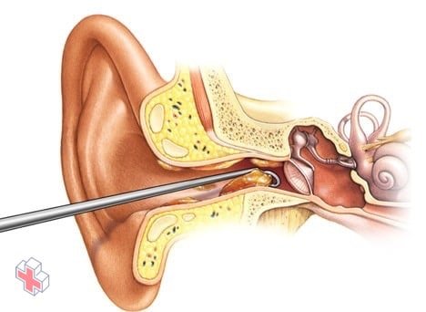 Illustration showing earwax removal by a doctor