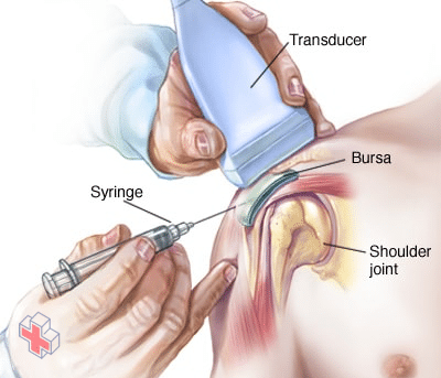 Injection into shoulder bursa