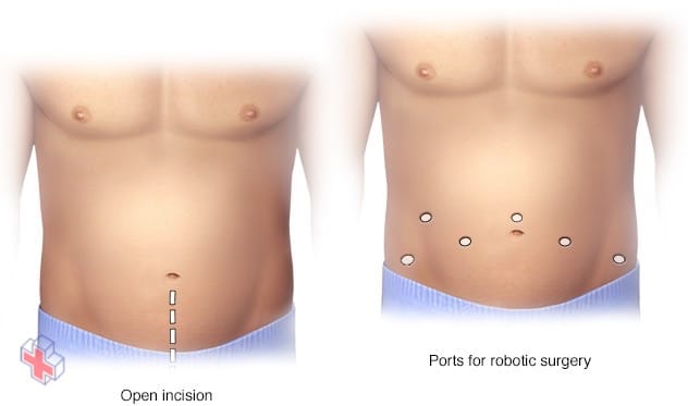 Location of incisions for open prostatectomy compared with robotic prostatectomy