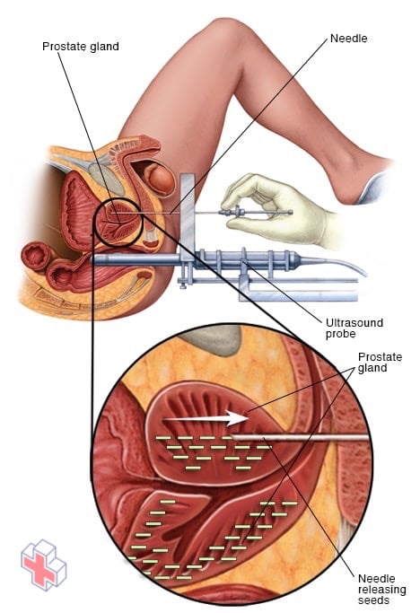 Permanent prostate brachytherapy