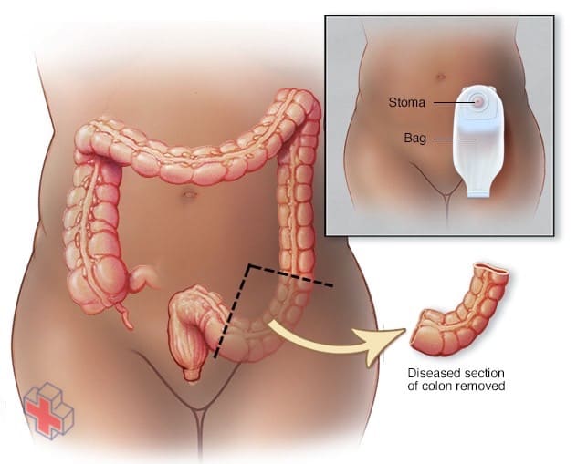 Partial colectomy surgery for colon cancer