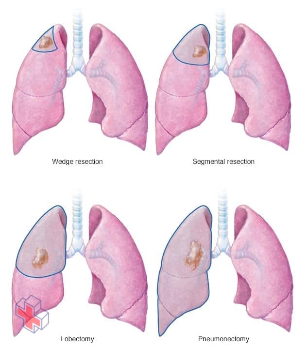 Lung cancer surgery