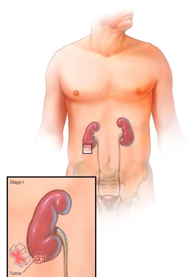 Stage I kidney tumor