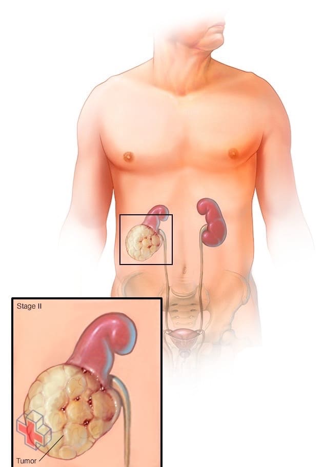 Stage II kidney tumor