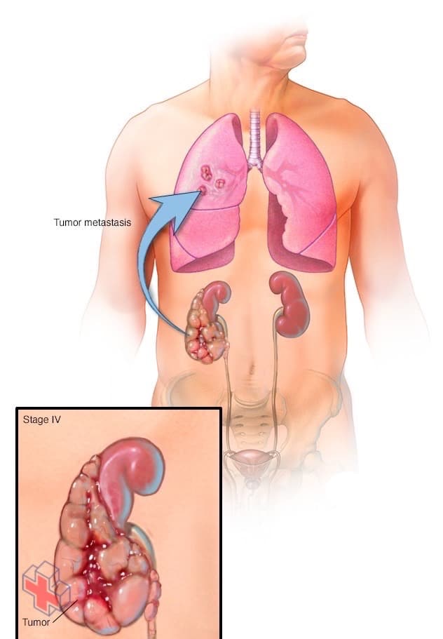 Stage IV kidney tumor