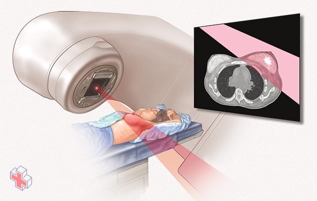 Radiation therapy for breast cancer