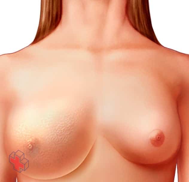 Photograph of woman with inflammatory breast cancer