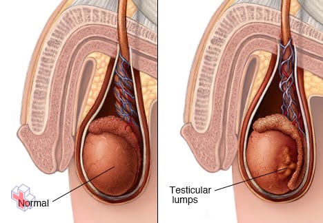 Image showing testicular lumps