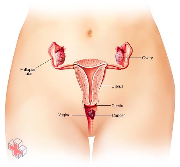 Vaginal cancer
