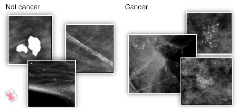 Mammogram images showing breast calcifications