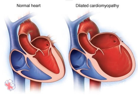 Dilated cardiomyopathy