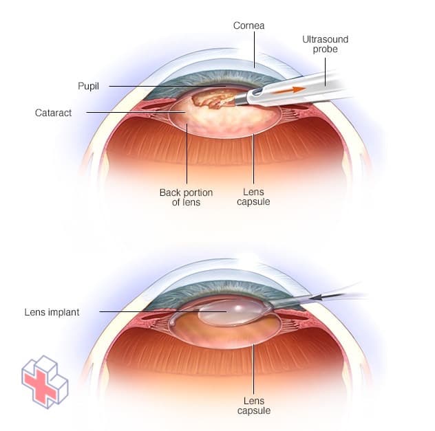Illustration showing two of the steps in cataract surgery