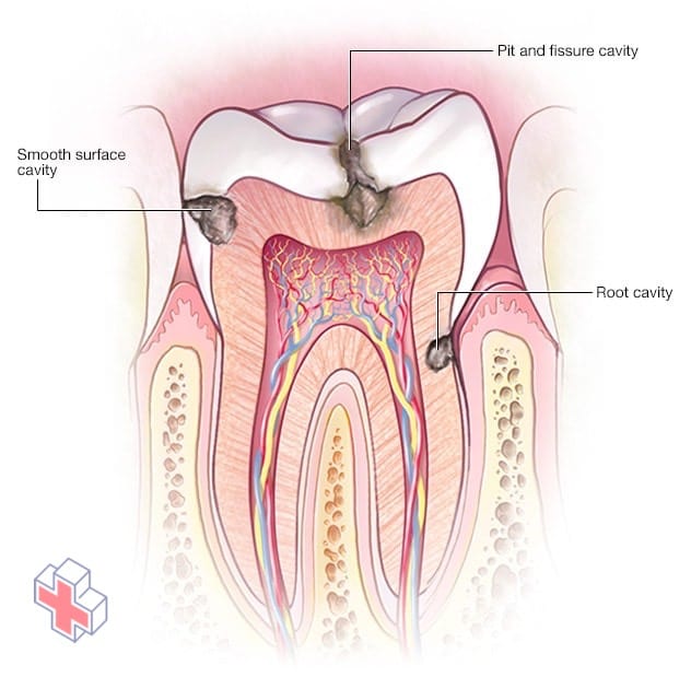 Types of cavities