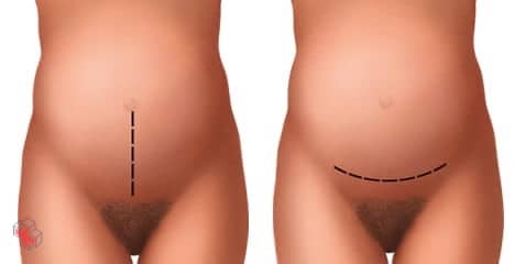 Abdominal incisions used during C-sections
