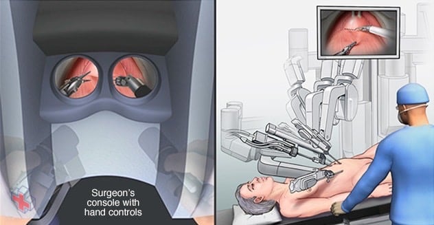 Surgeon's console and robotic instruments for cystectomy