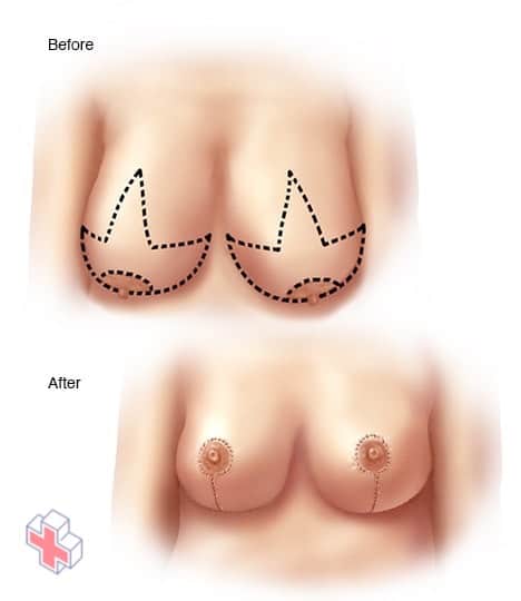 Incisions made for breast reduction surgery