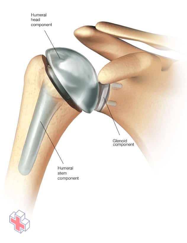 Anatomic total shoulder replacement