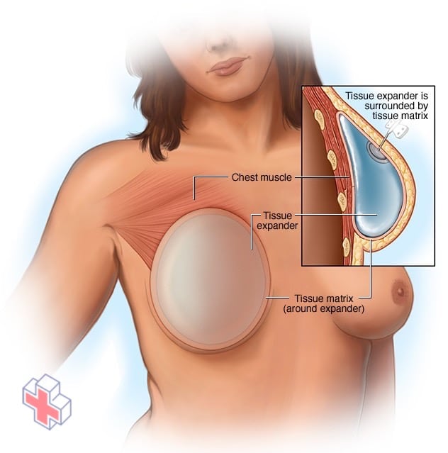 Breast reconstruction with a breast implant placed above the chest muscle