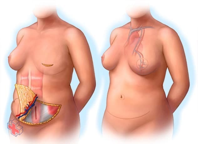During and after images of breast reconstruction using the DIEP flap procedure