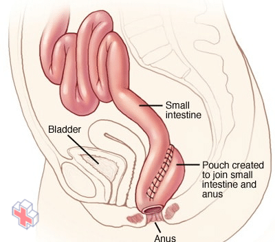 Illustration of ileoanal anastomosis