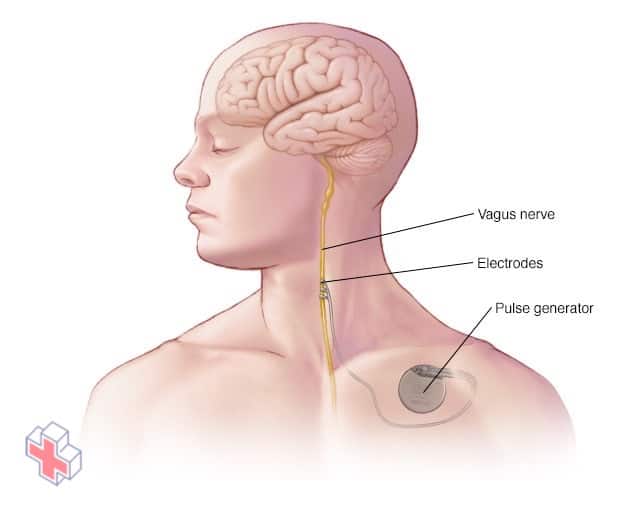 Device placement in vagus nerve stimulation