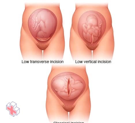 Uterine incisions used during C-sections