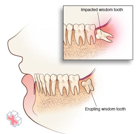 Erupting and impacted wisdom teeth