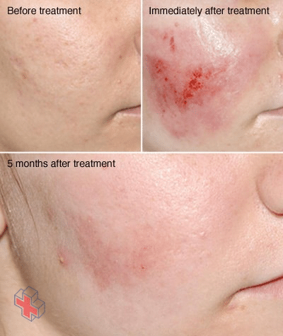 Before, immediately after and months after dermabrasion photos