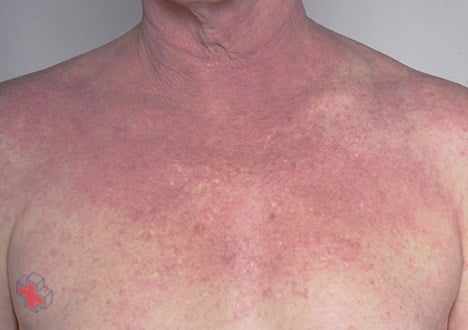 Atopic dermatitis on the chest