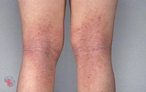 Atopic dermatitis on the legs