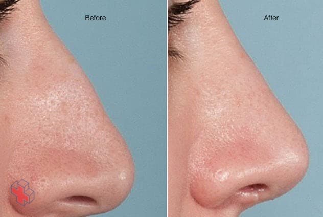 Before-and-after results of rhinoplasty