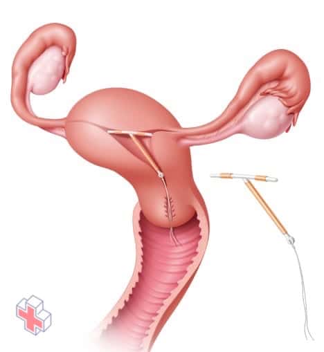 Illustration showing ParaGard IUD in place in the uterus