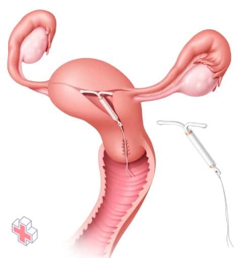 Illustration showing Mirena in place in the uterus
