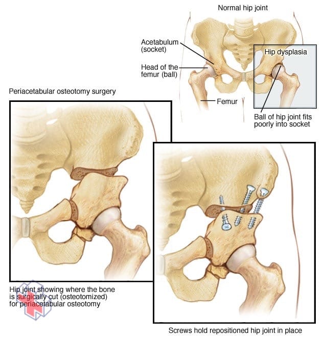 Periacetabular osteotomy