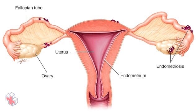 Endometriosis deposits on uterus and ovaries