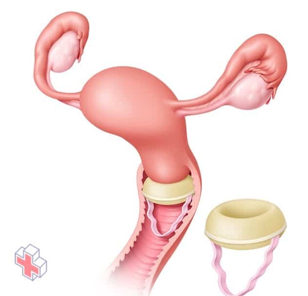 Contraceptive sponge in place over the cervix
