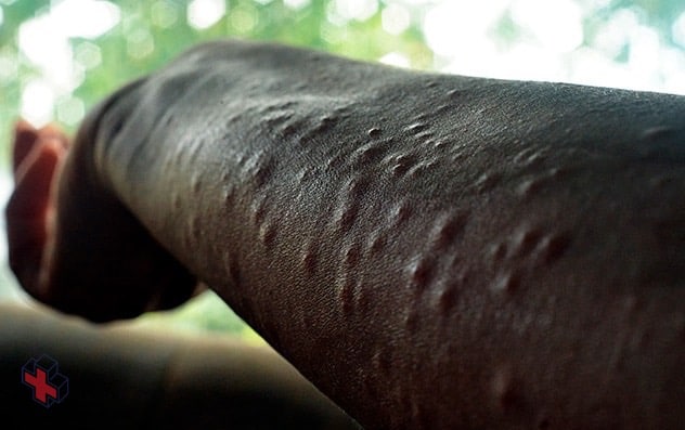 Arm covered with bumps caused by poison ivy