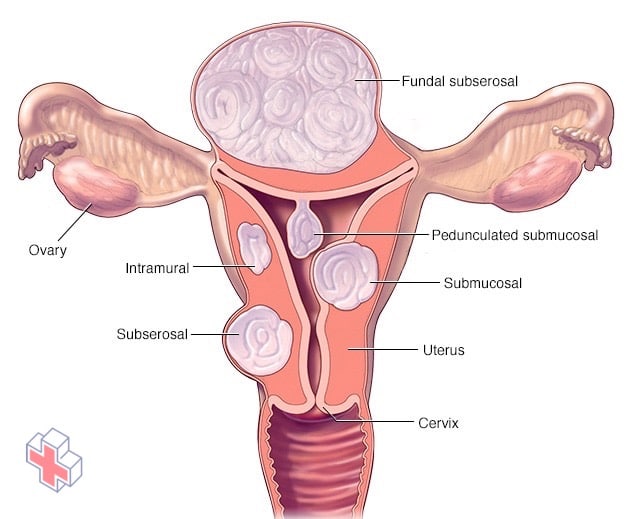 Different types of uterine fibroids and their locations