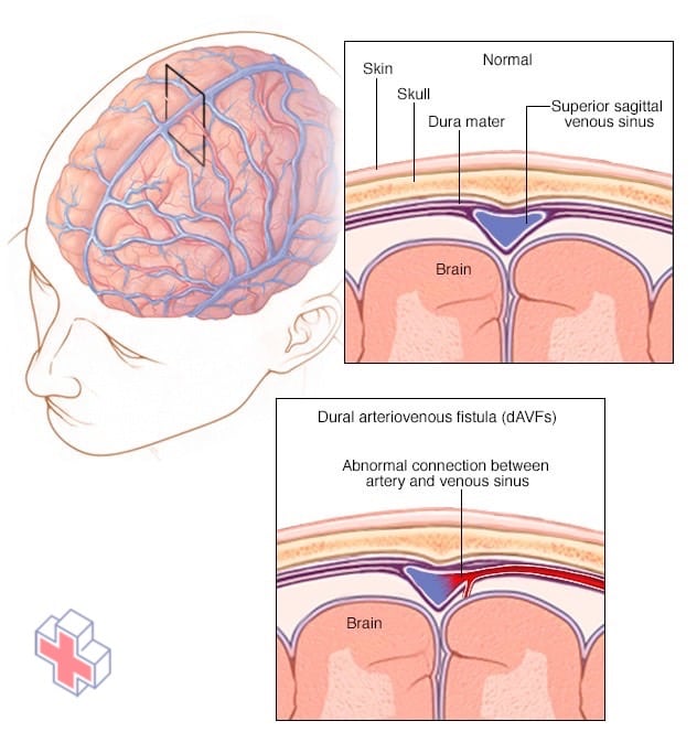 Dural arteriovenous fistula formation in the brain