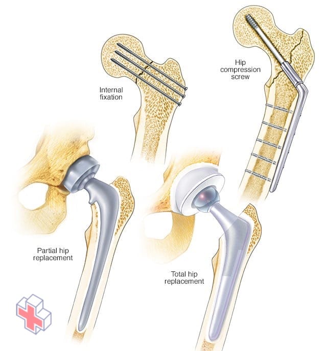 Hip fracture repair techniques