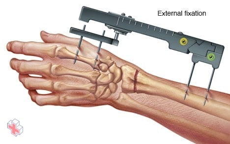 External fixation of a broken wrist