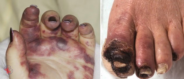 Images showing gangrene of the hand and foot
